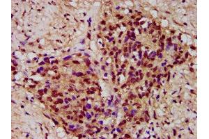 IHC image of ABIN7166863 diluted at 1:300 and staining in paraffin-embedded human ovarian cancer performed on a Leica BondTM system. (PYGO2 antibody  (AA 175-325))