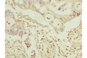Immunohistochemistry of paraffin-embedded human pancreatic cancer using ABIN7159917 at dilution of 1:100 (TOMM34 antibody  (AA 1-309))