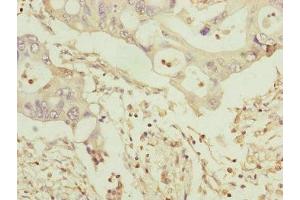Immunohistochemistry of paraffin-embedded human pancreatic cancer using ABIN7159917 at dilution of 1:100