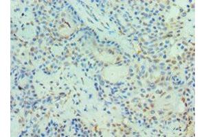 Immunohistochemistry of paraffin-embedded human breast cancer using ABIN7150969 at dilution of 1:100 (PIAS3 antibody  (AA 399-628))