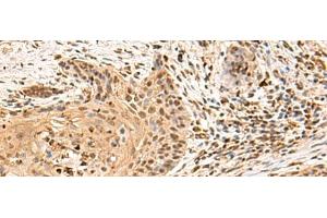 Immunohistochemistry of paraffin-embedded Human esophagus cancer tissue using PTH1R Polyclonal Antibody at dilution of 1:65(x200) (PTH1R antibody)