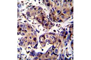 Immunohistochemistry (Formalin/PFA-fixed paraffin-embedded sections) of human breast cancer tissue withMAGEA3 polyclonal antibody . (MAGEA3 antibody  (AA 283-314))