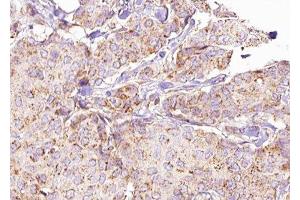 ABIN6276290 at 1/100 staining Human breast cancer tissue by IHC-P. (ATG5 antibody  (C-Term))