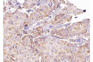 ABIN6276290 at 1/100 staining Human breast cancer tissue by IHC-P.