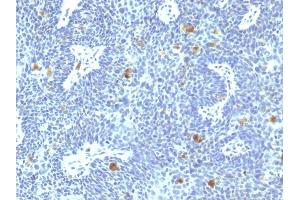 Formalin-fixed, paraffin-embedded human Cervix stained with HPV-16 Mouse Monoclonal Antibody (HPV16/1295). (HPV16 antibody)