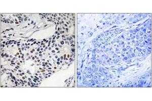 Immunohistochemistry analysis of paraffin-embedded human breast carcinoma, using WEE1 (Phospho-Ser53) Antibody. (WEE1 antibody  (pSer53))