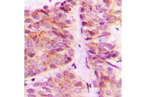 Immunohistochemical analysis of S6K1 staining in human breast cancer formalin fixed paraffin embedded tissue section.
