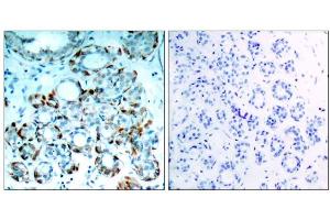 Immunohistochemical analysis of paraffin-embedded human breast carcinoma tissue, using BIM (phospho-Ser65) antibody (E011288). (BIM antibody  (pSer65, pSer69))