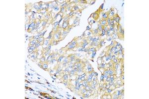 Immunohistochemistry of paraffin-embedded human prostate cancer using MANF antibody (ABIN6291535) at dilution of 1:100 (40x lens). (MANF antibody)