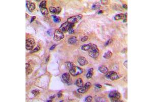 Immunohistochemical analysis of PKA C alpha/beta staining in human breast cancer formalin fixed paraffin embedded tissue section. (PKA/C alpha/beta (N-Term) antibody)