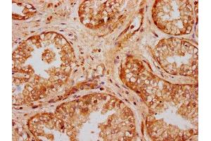 IHC image of ABIN7175133 diluted at 1:300 and staining in paraffin-embedded human prostate cancer performed on a Leica BondTM system. (UMODL1 antibody  (AA 537-654))