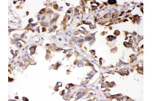 ALDH7A1 was detected in paraffin-embedded sections of human lung cancer tissues using rabbit anti- ALDH7A1 Antigen Affinity purified polyclonal antibody (Catalog # ) at 1 ?
