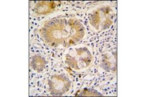 Formalin-Fixed, Paraffin-Embedded human colon carcinoma tissue reacted with Autophagy APG16L antibody (C-term), which was peroxidase-conjugated to the secondary antibody, followed by DAB staining. (ATG16L1 antibody  (C-Term))