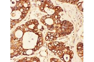 IHC-P: Src antibody testing of human intestinal cancer tissue (Src antibody  (AA 2-368))