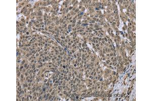 Immunohistochemistry of Human breast cancer using DCTN4 Polyclonal Antibody at dilution of 1:30 (Dynactin 4 antibody)