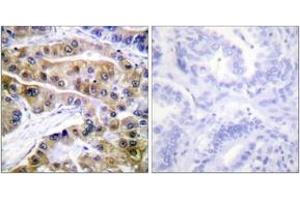 Immunohistochemistry analysis of paraffin-embedded human lung carcinoma, using ATPase (Phospho-Ser16) Antibody. (ATPase antibody  (pSer16))