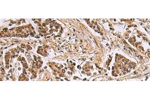 Immunohistochemistry of paraffin-embedded Human breast cancer tissue using DNA2 Polyclonal Antibody at dilution of 1:40(x200) (DNA2 antibody)