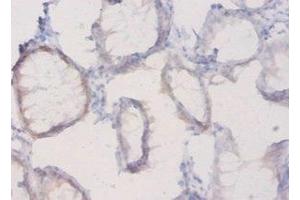 Immunohistochemistry of paraffin-embedded human colon cancer using ABIN7163695 at dilution of 1:20 (Plexin A1 antibody  (AA 32-296))