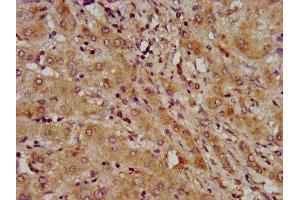 IHC image of ABIN7158792 diluted at 1:600 and staining in paraffin-embedded human liver cancer performed on a Leica BondTM system.