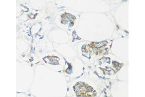 Immunohistochemistry of paraffin-embedded Human mammary cancer using NMT1 Polyclonal Antibody at dilution of 1:100 (40x lens).