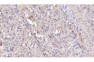 ABIN6273313 at 1/100 staining Human thyroid cancer tissue by IHC-P. (SAT1 antibody  (C-Term))