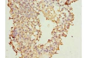 Immunohistochemistry of paraffin-embedded human breast cancer using ABIN7145623 at dilution of 1:100 (NUDT2 antibody  (AA 1-147))