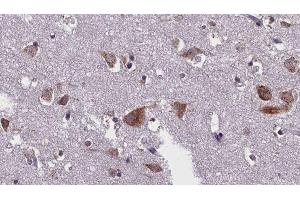 ABIN6276299 at 1/100 staining Human brain cancer tissue by IHC-P. (Caspase 10 antibody)
