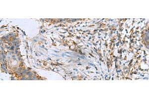 Immunohistochemistry of paraffin-embedded Human esophagus cancer tissue using RPL10A Polyclonal Antibody at dilution of 1:50(x200) (RPL10A antibody)