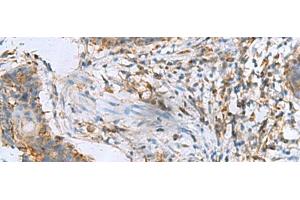 Immunohistochemistry of paraffin-embedded Human esophagus cancer tissue using RPL10A Polyclonal Antibody at dilution of 1:50(x200)