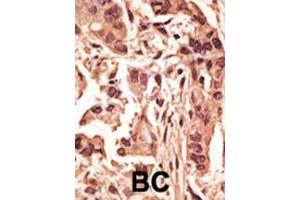 Formalin-fixed and paraffin-embedded human cancer tissue reacted with the primary antibody, which was peroxidase-conjugated to the secondary antibody, followed by DAB staining. (SIRT6 antibody  (C-Term))