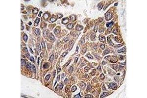 IHC analysis of FFPE human lung carcinoma tissue stained with AKT2 antibody (AKT2 antibody  (AA 416-444))