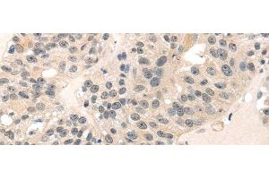 Immunohistochemistry of paraffin-embedded Human breast cancer using MED28 Polyclonal Antibody at dilution of 1/30 (MED28 antibody)