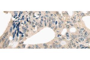 Immunohistochemistry of paraffin-embedded Human colorectal cancer tissue using ETV4 Polyclonal Antibody at dilution of 1:25(x200) (ETV4 antibody)
