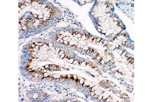 IHC-P: IGF2R antibody testing of human intestine cancer tissue (IGF2R antibody  (C-Term))