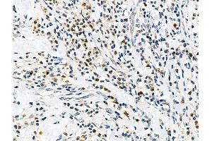 ABIN6258629 and ABIN6275742 at 1/100 staining Human esophageal cancer by IHC-P. (Elf4 antibody  (Internal Region))