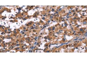 Immunohistochemistry of paraffin-embedded Human thyroid cancer tissue using R3HCC1L Polyclonal Antibody at dilution 1:40 (GIDRP88 antibody)