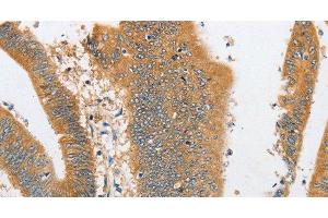 Immunohistochemistry of paraffin-embedded Human colon cancer tissue using ARHGAP5 Polyclonal Antibody at dilution 1:30 (ARHGAP5 antibody)