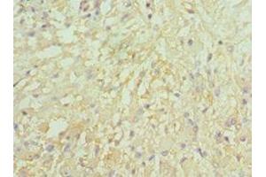 Immunohistochemistry of paraffin-embedded human glioma using ABIN7157975 at dilution of 1:100 (Leiomodin 1 antibody  (AA 29-187))