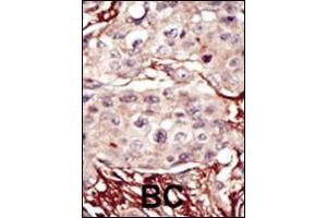 Formalin-fixed and paraffin-embedded human cancer tissue reacted with the primary antibody, which was peroxidase-conjugated to the secondary antibody, followed by DAB staining. (Aurora-B (ARK/STK12) (AA 283-313) antibody)