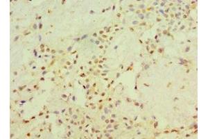 Immunohistochemistry of paraffin-embedded human breast cancer using ABIN7170704 at dilution of 1:100 (STARD3 antibody  (AA 170-445))