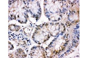 IHC-P: MCM5 antibody testing of human intestinal cancer tissue (MCM5 antibody  (C-Term))