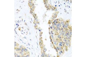 Immunohistochemistry of paraffin-embedded human lung cancer using DARS2 antibody. (DARS2 antibody  (AA 406-645))