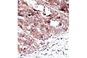 Formalin-fixed and paraffin-embedded human cancer tissue (hepatocarcinoma) reacted with the primary antibody, which was peroxidase-conjugated to the secondary antibody, followed by AEC staining. (PHKG2 antibody  (N-Term))