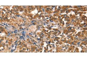 Immunohistochemistry of paraffin-embedded Human thyroid cancer tissue using AGO1 Polyclonal Antibody at dilution 1:40 (AGO1 antibody)