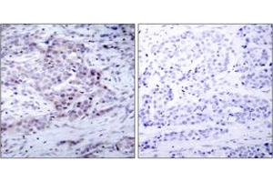 Immunohistochemistry analysis of paraffin-embedded human breast carcinoma, using NF-kappaB p100/p52 (Phospho-Ser869) Antibody.