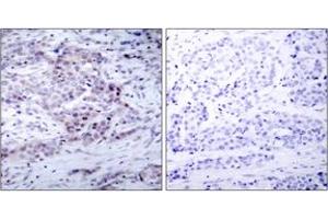 Immunohistochemistry analysis of paraffin-embedded human breast carcinoma, using NF-kappaB p100/p52 (Phospho-Ser869) Antibody. (NFKB2 antibody  (pSer870))