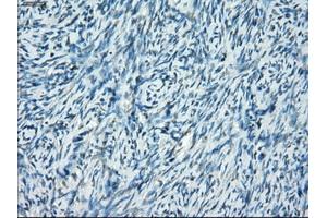 Immunohistochemical staining of paraffin-embedded Adenocarcinoma of breast tissue using anti-SSX2 mouse monoclonal antibody.