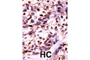 Formalin-fixed and paraffin-embedded human cancer tissue reacted with the primary antibody, which was peroxidase-conjugated to the secondary antibody, followed by DAB staining. (UCK2 antibody  (N-Term))