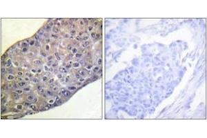 Immunohistochemistry analysis of paraffin-embedded human breast carcinoma tissue, using RhoA (Ab-188) Antibody.