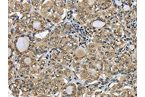 The image on the left is immunohistochemistry of paraffin-embedded Human thyroid cancer tissue using ABIN7131308(TBL1Y Antibody) at dilution 1/20, on the right is treated with fusion protein. (TBL1Y antibody)